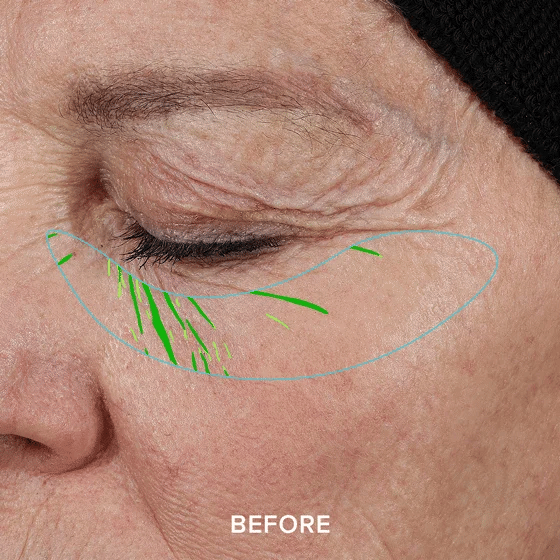 Close-up of a closed eye with a graphic overlay, labeled 'Before.'