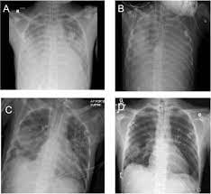 Natravor™ Herbal Mullein Lung Purifier